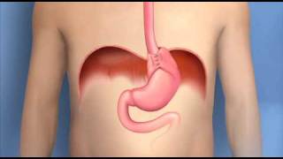 Antireflux Surgery FundoplicationMayo Clinic [upl. by Mose465]