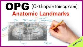 Orthopantomogram OPG Anatomical Landmarks  Radiology [upl. by Aimaj]