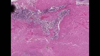 Histopathology Testis Embryonal carcinoma [upl. by Ogren]