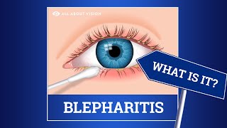 Blepharitis red swollen eyelids Causes Symptoms Treatments [upl. by Yatnahs]