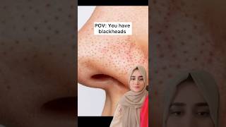 Solution of blackheads  acne  pimples  whiteheads  blemishes  trending [upl. by Benyamin]