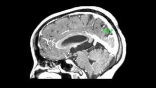 Endoscopic treatment of a third ventricle choroid plexus cyst [upl. by Anihs574]