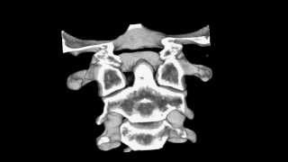 Cervical spine CT scan Atlantoaxial subluxation [upl. by Sinnod589]