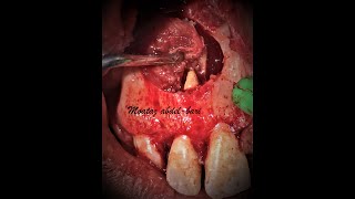 enucleation of maxillary radicular cyst with PRF placement [upl. by Lonna925]