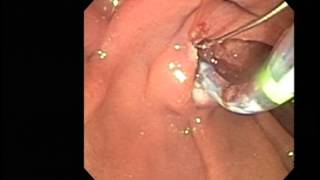 ERCP sphincterotomy stone extraction [upl. by Yelik]