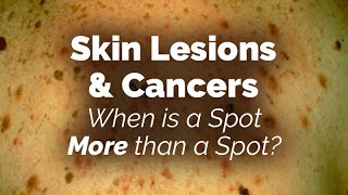 When is a Spot More than a Spot Skin Lesions and Cancers [upl. by Nevram]