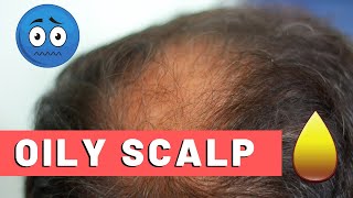 Oily Scalp Treatment For Hair Loss The Best Way [upl. by Boehmer551]