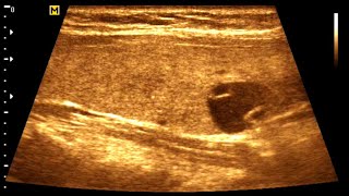 Thyroid nodule  Cystic nodule  Thyroid cyst [upl. by Arihay416]