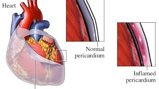 Pericarditis [upl. by Ayital]