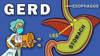 Gastroesophageal Reflux Disease GERD [upl. by Aggarwal942]