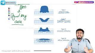 10 Gastric tumours  Benign and Malignant   USMLE Step 1 Pathology [upl. by Eecrad440]