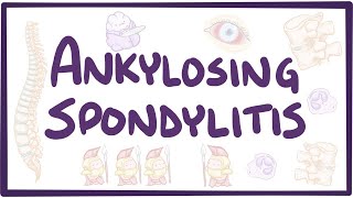 Ankylosing spondylitis  causes symptoms diagnosis treatment pathology [upl. by Trin]