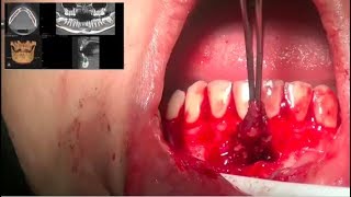 Radicular Cyst Enucleation [upl. by Aphrodite]