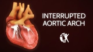 Interrupted Aortic Arch − Ventricular Septic Defect [upl. by Zorana]