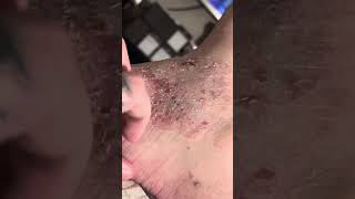 Eczema psoriasis asmr scratching 2 [upl. by Uhile]