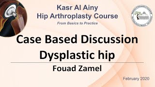 44 Dysplastic hip  Fouad Zamel [upl. by Nesmat755]