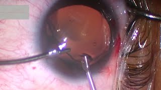 ICL Implantable Collamer Lens Exchange and Replacement My Safe and Easy TwoHanded Technique [upl. by Woodsum]