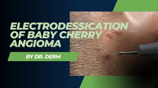 Electrodessication of Baby Cherry Angioma  Dr Derm [upl. by Aicilec296]