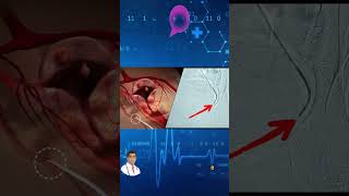 Uterine Fibroid Embolization Live Surgery [upl. by Copland]