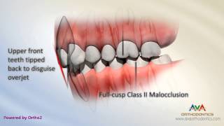 Malocclusion  Class II Div 2 [upl. by Ocer508]