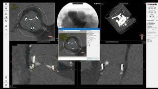 3Mensio CT precase planning ValveinValve TAVR in PerimountMagna Surgical Aortic Valve SAV [upl. by Irreg]