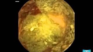 Small Bowel Capsule Endoscopy Visualizing Colonic Adenocarcinoma [upl. by Inessa508]