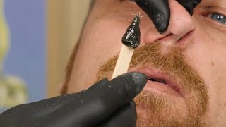 Nose Hair WAXING  Black Sugar Wax for NOSE HAIR Removal [upl. by Kellda]