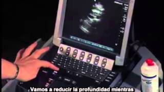 Procedimiento para realizar un examen ecográfico de la aorta abdominal [upl. by Rojas]