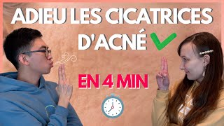 En finir avec les cicatrices d’acné en 4 minutes [upl. by Ruford379]