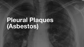 AsbestosRelated Pleural Plaques [upl. by Penrose]