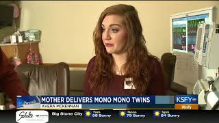 Mothers pregnancy journey with Mono Mono twins  Medical Minute [upl. by Nnylhsa]