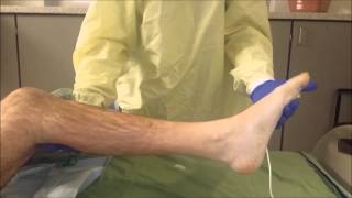 Ankle clonus [upl. by Rheba]