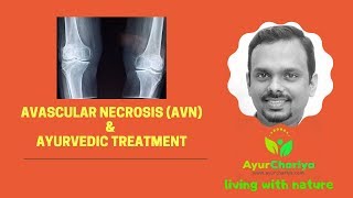 Avascular Necrosis or AVN amp Ayurvedic Treatment avascular necrosis of hip treatment in hindi [upl. by Hgielsa]