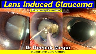 Phacomorphic Lens Induced Glaucoma  Phacoemulsification ChallengesDr Deepak Megur [upl. by Eessej]