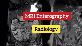 MR Enterography  Small bowel disorde  MRI imaging Radiology [upl. by Nee879]