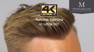 FUE Hair Transplant in England 1074 Grafts Two Year Before and After in Ultra HD [upl. by Aisercal]