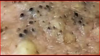 Pimple Popping Blackheads On Skin 😲😲 [upl. by Assili]