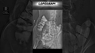 Distal Lopogram  Large bowel  cologram loogopgram [upl. by Aekal]