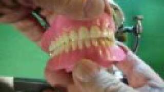 UL Dentures wax setup using a quotPrecision Coordinatorquot Ar [upl. by Nyre215]