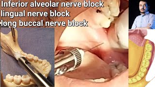 Local Anesthesia Inferior Alveolar Nerve block amp long buccal Nerves block Mandibular nerve block [upl. by Sirret]