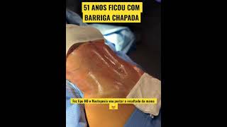 51 ANOS COM A BARRIGA CHAPADA  CIRURGIA PLÁSTICA [upl. by Albertine]