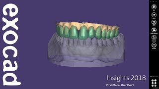 INSIGHTS 2018 DentalCAD Case Demonstration  Thimble crown implant bridge [upl. by Nerrot]