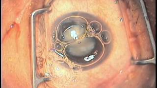 Anterior capsular dyes  ICG VS Trypan blue [upl. by Wunder]