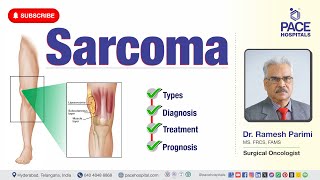 Sarcoma Cancer  Types Diagnosis Treatment amp Prognosis  sarcomatreatment [upl. by Shifra224]