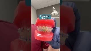 Metal Braces vs Ceramic Braces👀 [upl. by Airdnaid]