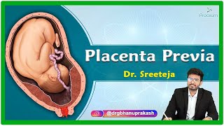 Placenta Previa Etiology Pathophysiology Clinical presentation Diagnosis and Treatment [upl. by Ardyce839]