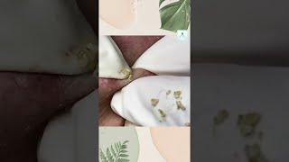 Big Cystic Acne Blackheads Extraction Blackheads amp Milia Whiteheads Removal Pimple Popping Shorts [upl. by Yancy]