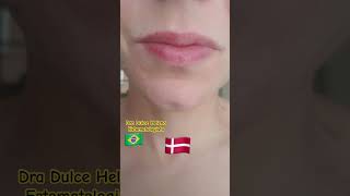 Queilite esfoliativa antes e depois Exfoliative cheilitis before and after [upl. by Neelear]