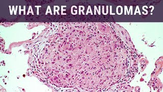 What are Granulomas  Pathology mini tutorial [upl. by Maher]