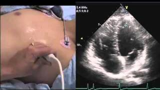 Intro to Echo Apical 4 Chamber Viewmov [upl. by Rowell]